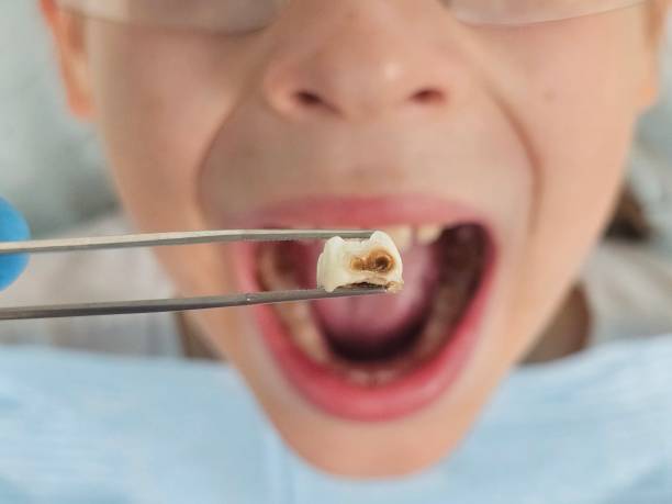 Best Emergency Dental Care for Broken or Chipped Teeth in Sunman, IN